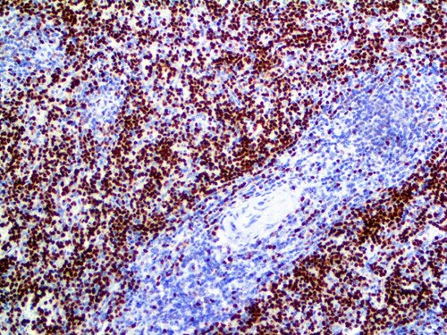 IHC of T-bet on an FFPE Lymphoma Tissue